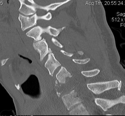 Cervical Spine Metastasis CT